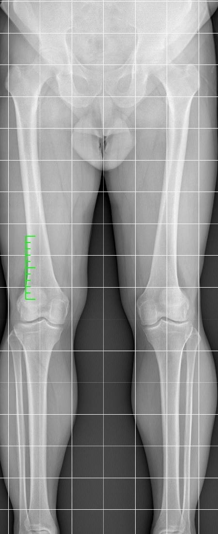Radiografia panoramica degli arti inferiori sotto carico per la valutazione dell’allineamento