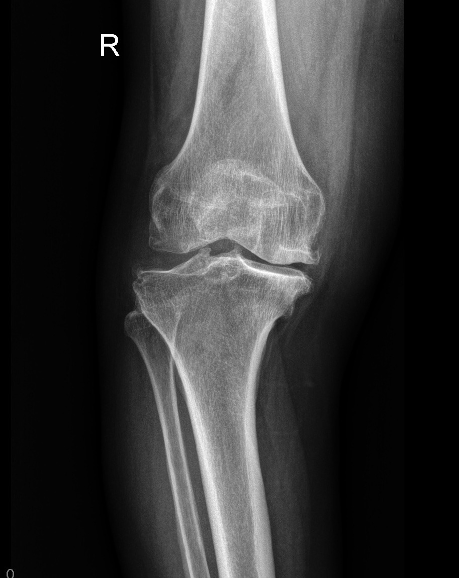 Radiografia del ginocchio con segni di gonartrosi